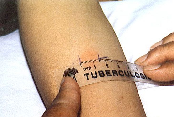 Jujuy la segunda provincia con peores indicadores de muertes por tuberculosis