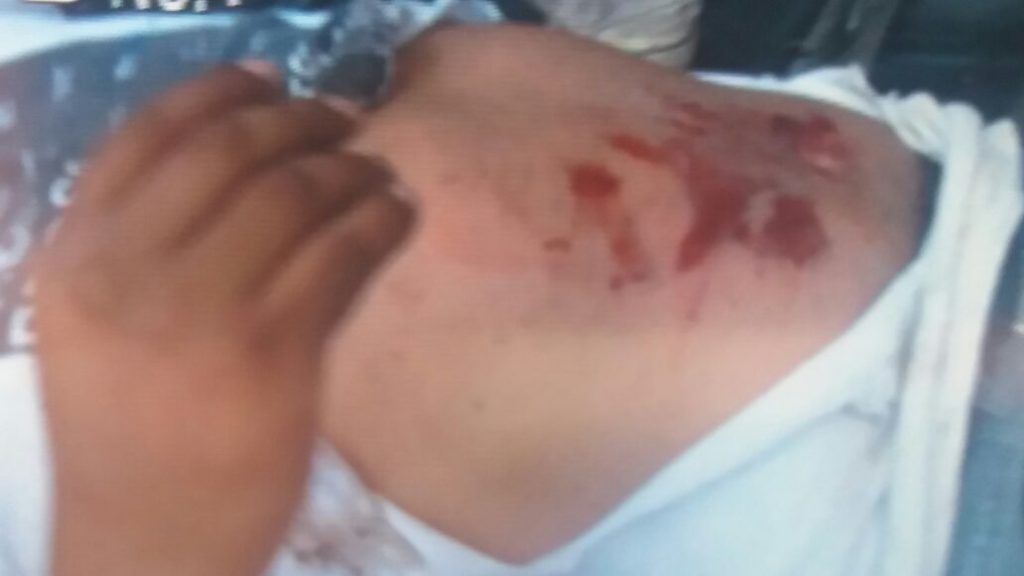 Jujuy: una bomba de estruendo arrojada por manifestante hirió a un camarógrafo